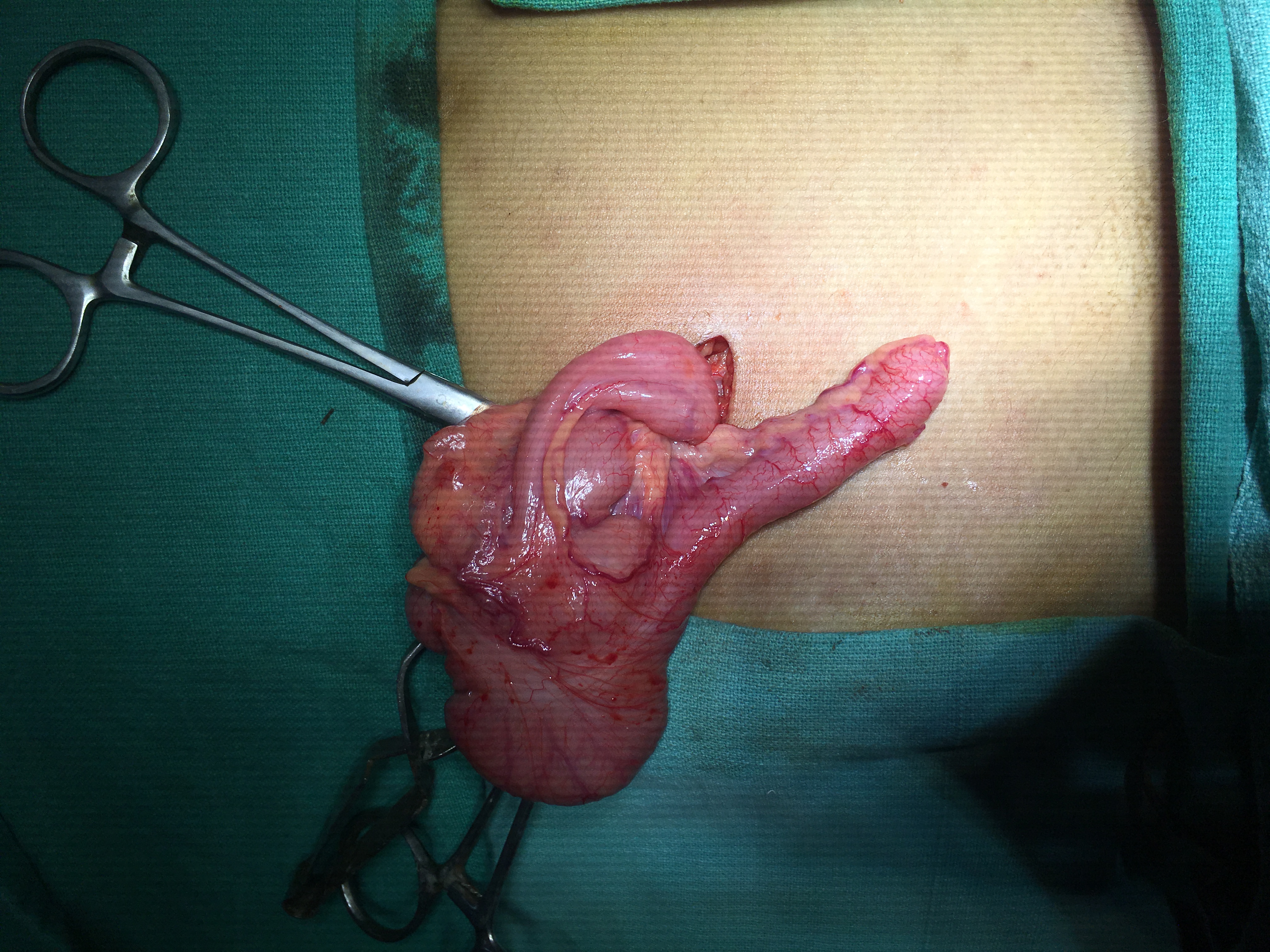 Pediatric G.I. Surgery Image 11